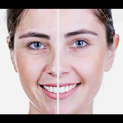 Anti Aging Procedure
