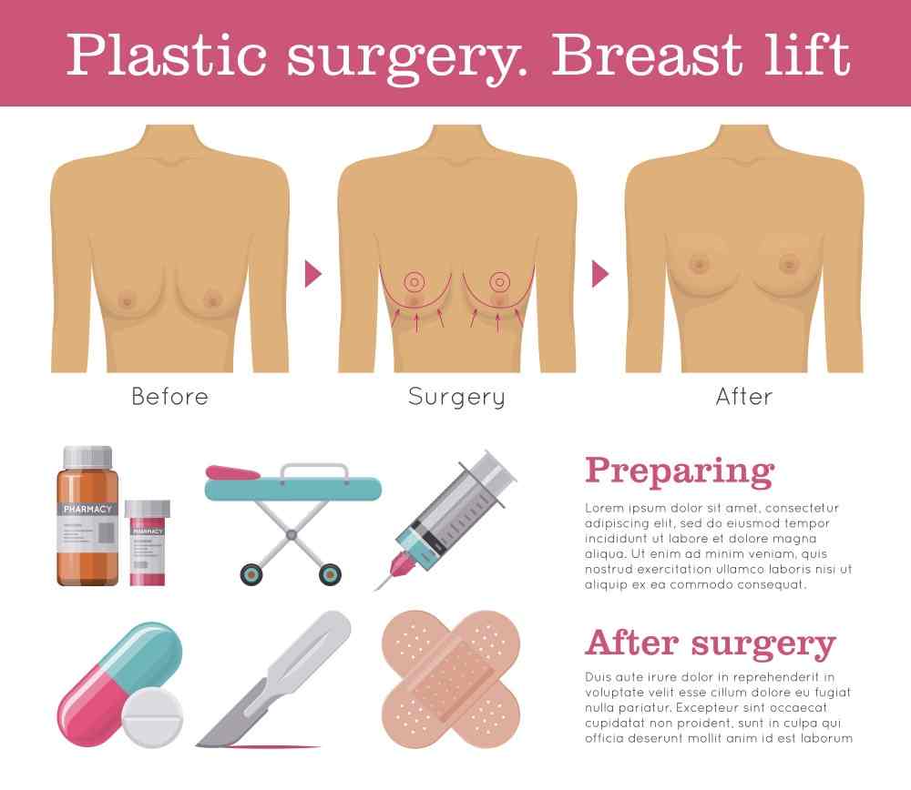 Breast Lift (Mastopexy)