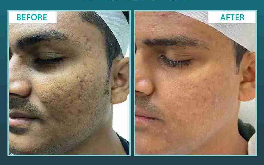 Skin Rejuvenation Treatment